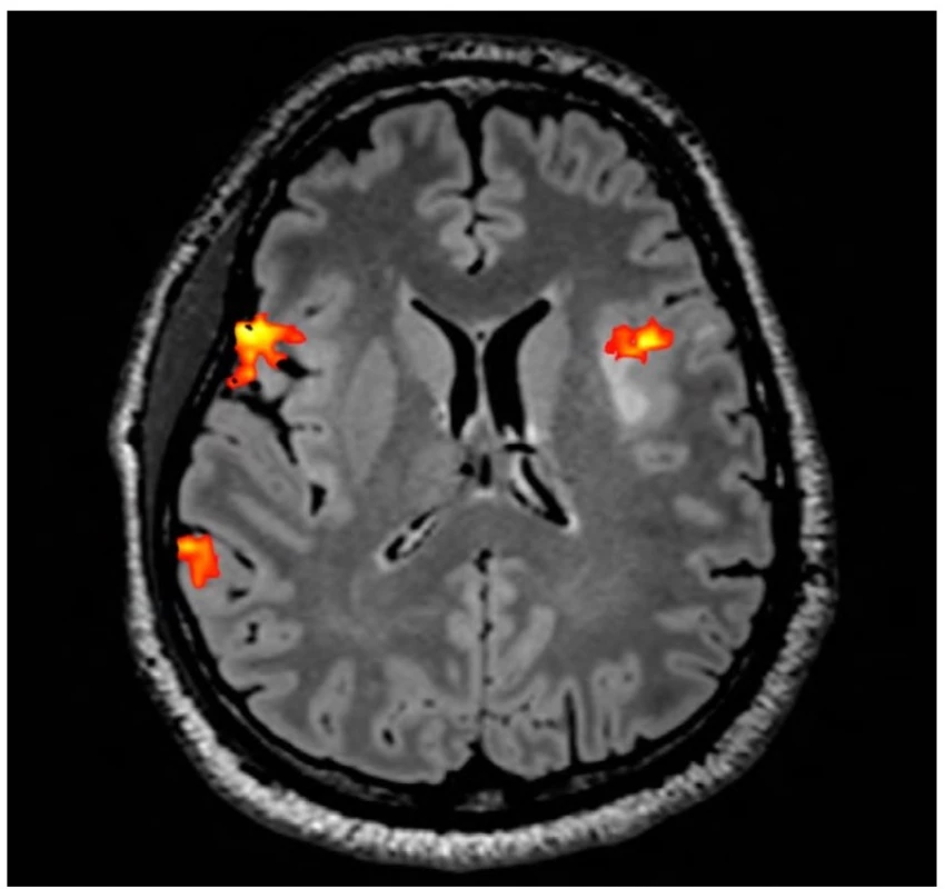 Pacient s dominantní aktivitou při řečových zkouškách v pravé mozkové hemisféře, aktivita se však objevuje i v levé
hemisféře v předpokládané oblasti motorického centra, navíc v těsném vztahu k tumoru v insulární krajině (světlé ložisko těsně
za oblastí aktivace)