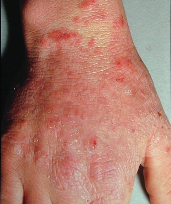 Typická rubrofycie (původce Trichophyton rubrum) na dorsu ruky