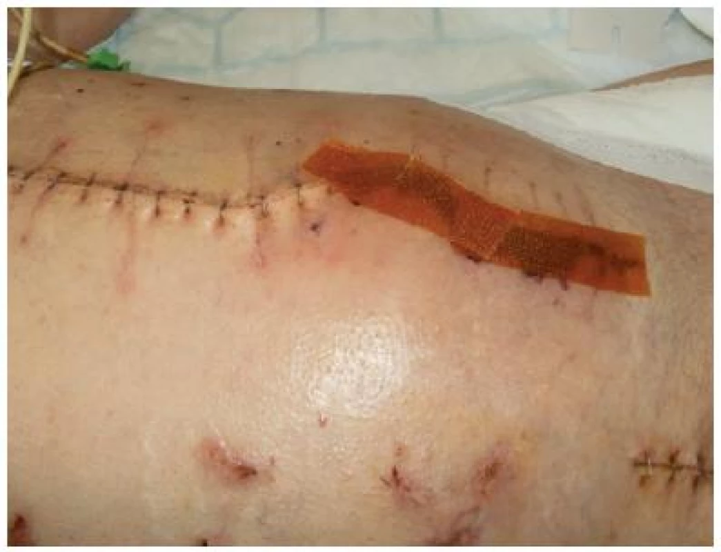 Ošetření sutury s nekrózou antiseptikem