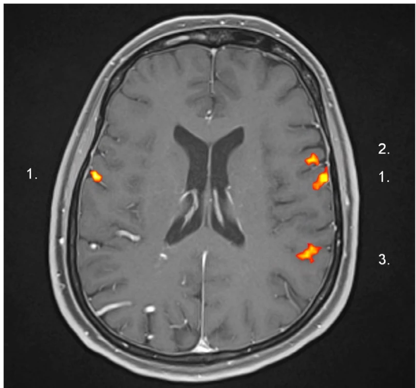 Ukázka nejčastějšího běžného obrazu aktivací motorických oblastí jazyka v obou hemisférách a řečových center v levé
dominantní hemisféře (1.), motorická Brocova (2.) a senzorická Wernickeova (3.) oblast