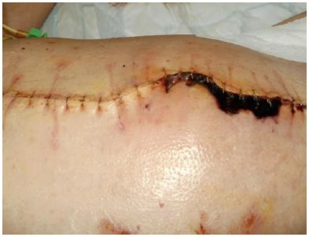 Ošetření sutury s nekrózou