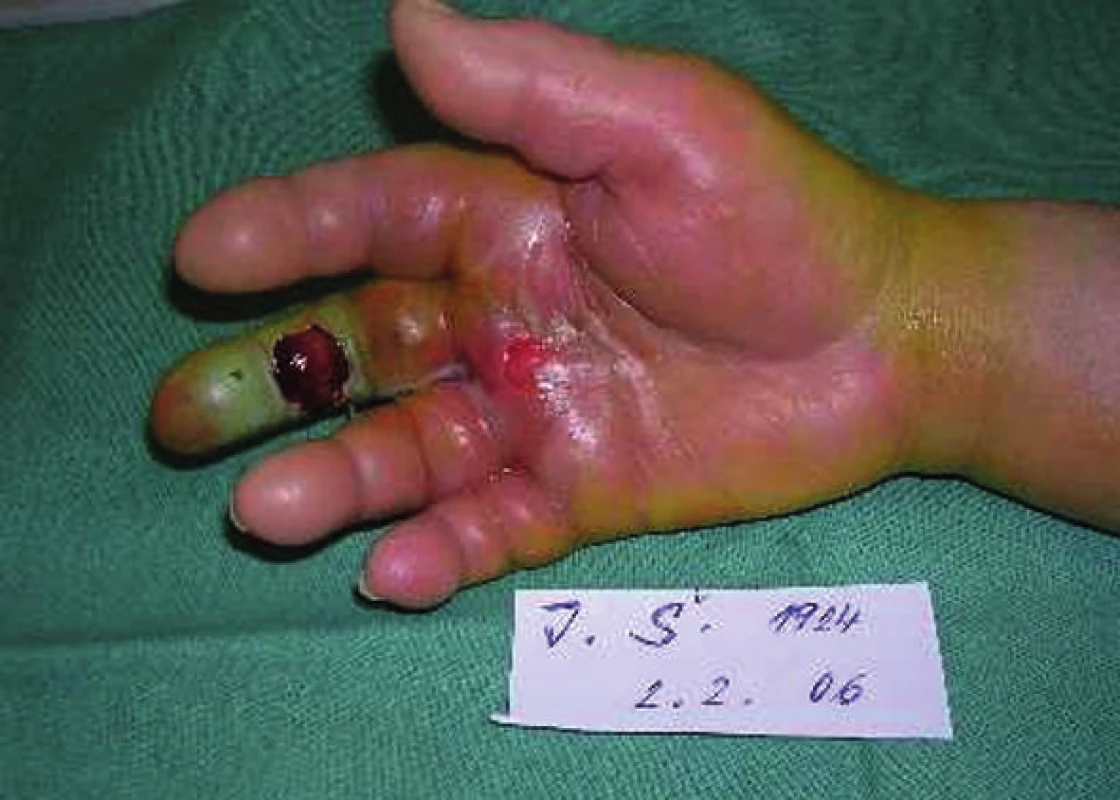 Kazuistika – gangréna prstu nejasné etiologie