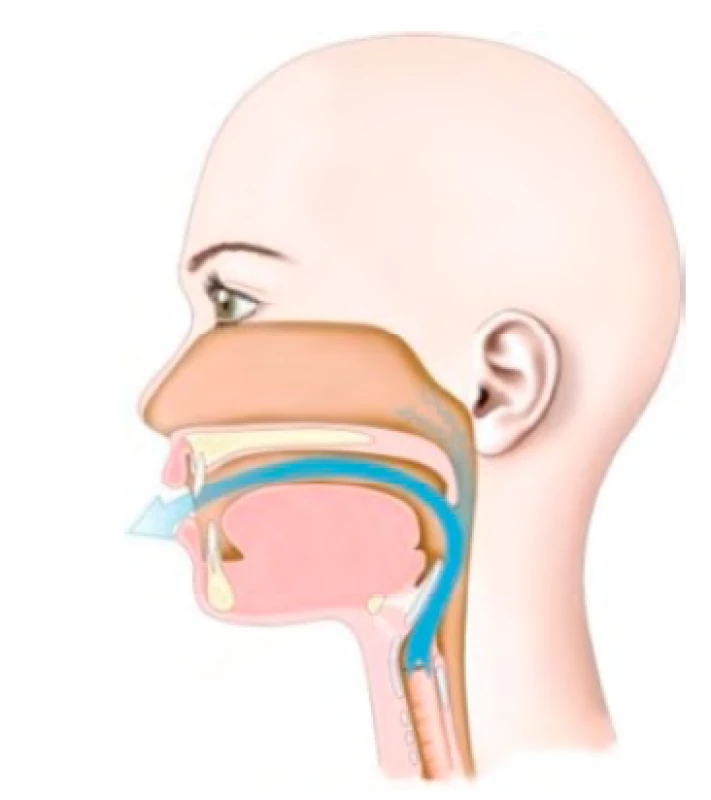 V dôsledku orgánovej a/alebo
funkčnej príčiny vzniká porucha
velofaryngeálneho mechanizmu